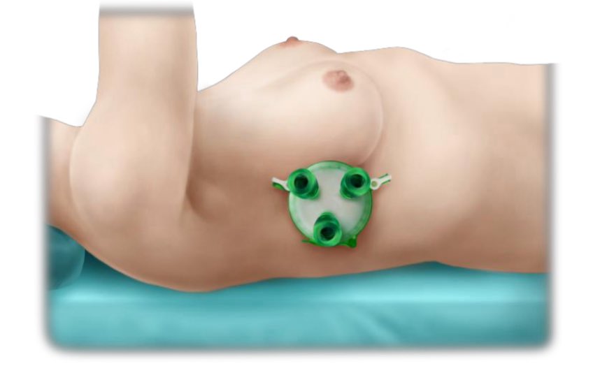 Grateful to be the 5th surgeon in the U.S. and 1st in NY to fully complete the Endoscopic Nipple Sparing Mastectomy

Smaller incisions and better recovery.
Innovation with impact. 💗

#eNSM #BreastSurgery #WomenInMedicine #Oncology #InnovationInSurge #DrBeaMD #NYPBMH