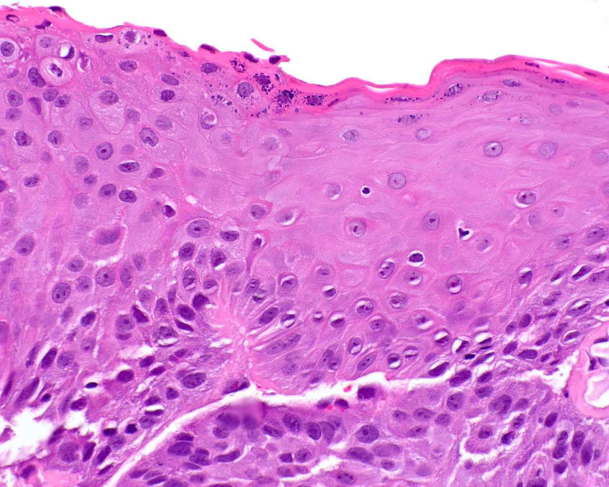 Esophageal epidermoid metaplasia (the presence of a granular layer) is likely a precursor to esophageal squamous cell carcinoma - a vintage report in Modern Pathology showed good evidence.
Singhi AD, Arnold CA, Lam-Himlin DM, Nikiforova MN, Voltaggio L, Canto MI, McGrath KM,