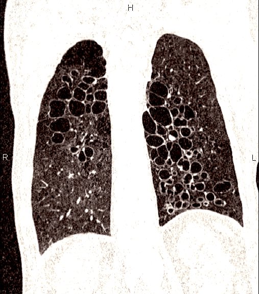 docxusofficial's tweet image. “Cluster of Grapes”

You only need 1 second to identify this

What pathology is it?