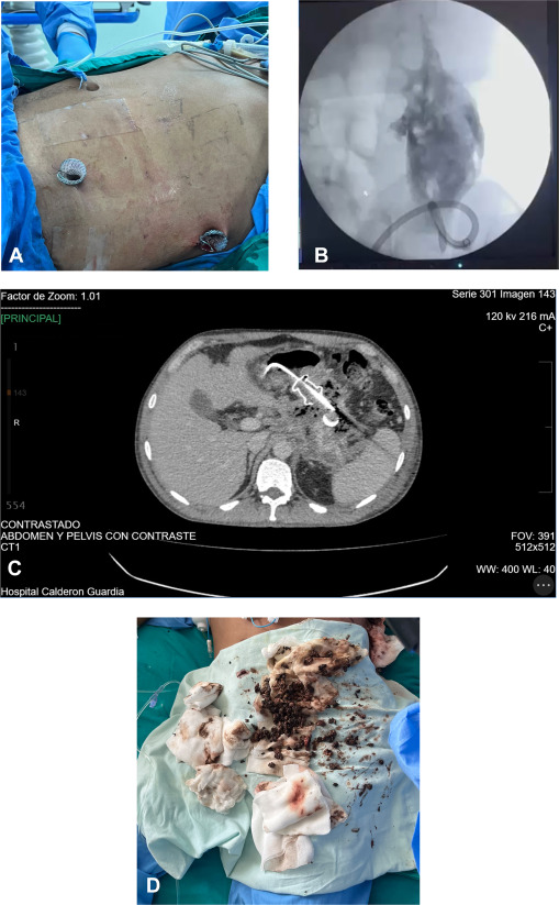 GIE_Journal's tweet image. At the Focal Point, Rodríguez et al demonstrate &quot;Percutaneous endoscopic necrosectomy by use of a fully covered self-expandable metal stent in a patient with severe acute necrotizing pancreatitis.&quot; giejournal.org/article/S0016-…

#GITwitter