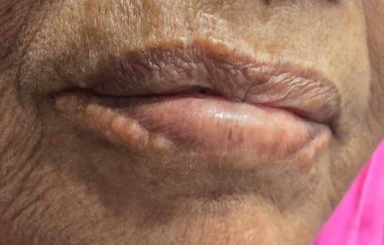 Diagnosis.....?
H/O CKD 
<a href="/Doctors__squad/">Dr Honey choudhary 🩺</a> 
<a href="/Doctors_GUILD/">MEDICINE MADNESS</a> 
<a href="/neoskinhealer/">Dr. ISHWAR N RATHORE MD</a>