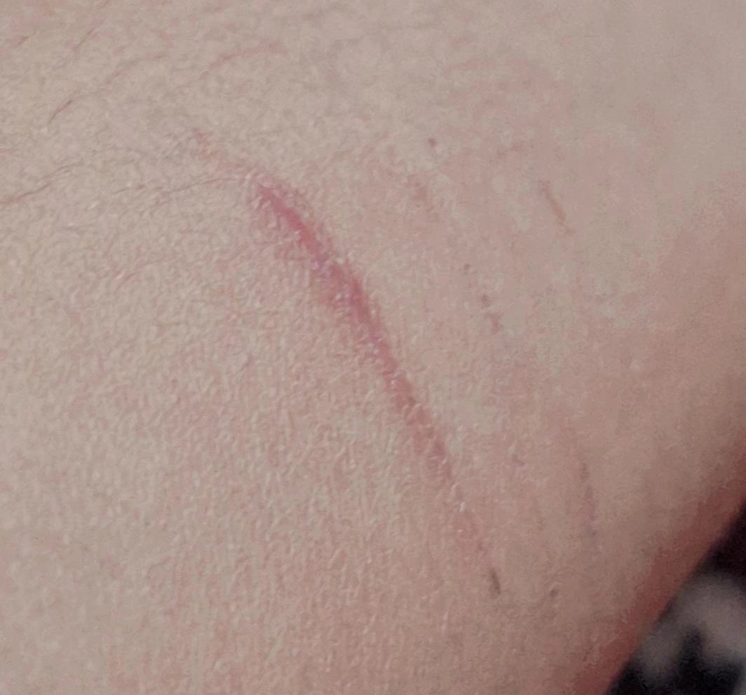 Mi primer cicatriz bonita