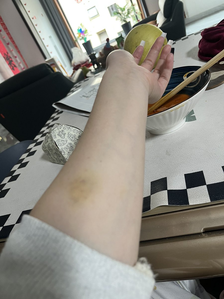 第五天前打麻将输了抽二条被抽紫了  现在变尸斑了