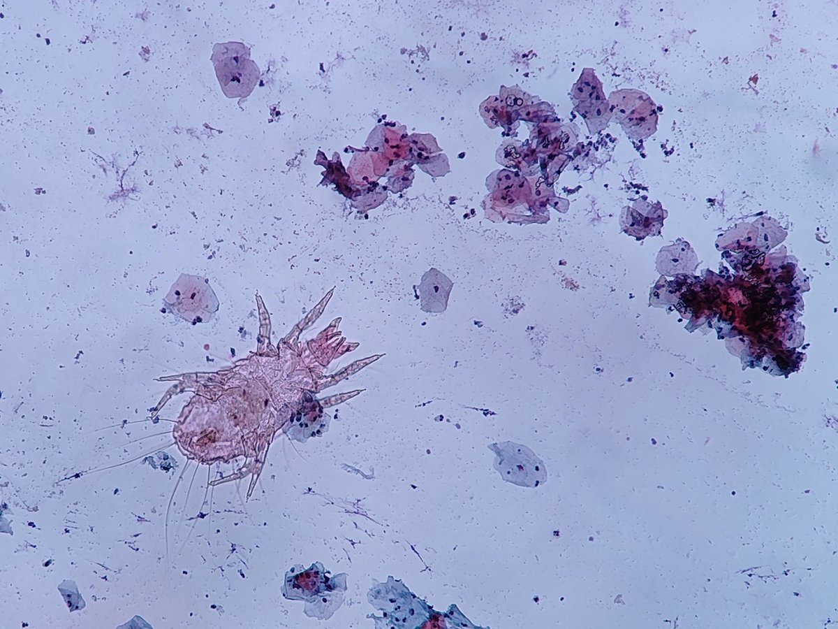 TjLimMD's tweet image. Found this in a pap smear... Bethesda doesn&apos;t  say anything about mites. 🙈
AI tagged this as sarcoptes... 80 to 90 % confidence. 

Anybody knows what this is?
@ParasiteGal (I hope you&apos;re around)
@VetPathophile (I know but you might see more of them than I do)
@DrGeeONE
