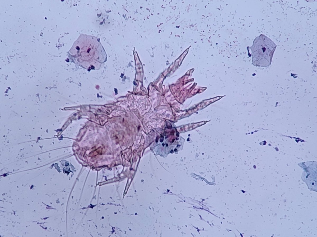 TjLimMD's tweet image. Found this in a pap smear... Bethesda doesn&apos;t  say anything about mites. 🙈
AI tagged this as sarcoptes... 80 to 90 % confidence. 

Anybody knows what this is?
@ParasiteGal (I hope you&apos;re around)
@VetPathophile (I know but you might see more of them than I do)
@DrGeeONE