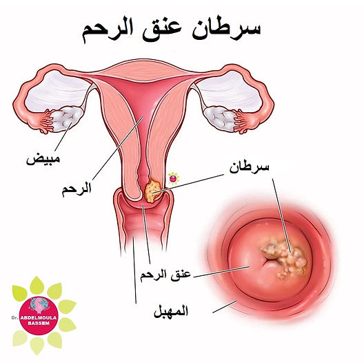 سرطان عنق الرحم يمكن الوقاية منه بنسبة تصل إلى 90% عبر لقاح HPV، وهو أحد أكثر السرطانات القابلة  للوقاية.

معظم الحالات تكتشف في مراحل متقدمة بسبب ضعف الفحص والوعي حول اهمية اللقاح وهذا يجعل العلاج أصعب ونسب النجاة أقل.

التطعيم  آمن وموصى به عالميا من منظمة الصحة العالمية ويعطى