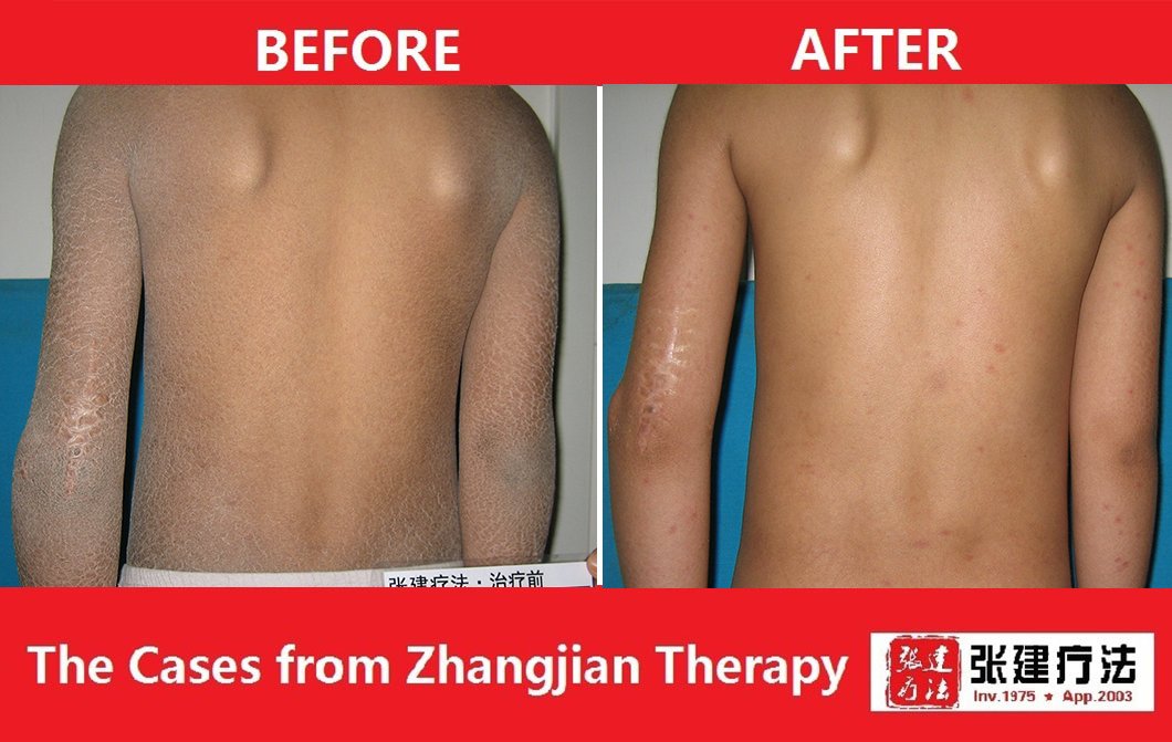 ZJTherapy's tweet image. 🤗Ichthyosis treatment 

14 days ichthyosis treatment change the skin

🤝If you want to know more about your skin, see successful ichthyosis treatment cases and skin care tips, please contact us to send you ichthyosis book. 
☎️Contact us: wa.me/message/A6E3X3…
 #Ichthyosis