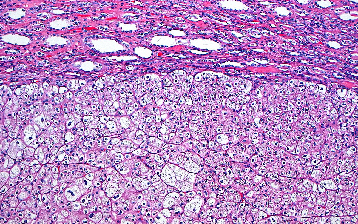 ziad_zaatari's tweet image. 🔬📷 &quot;On the Edge&quot; ~ Chromophobe Renal Cell Carcinoma ~ #GUpath #Pathology #PathArt