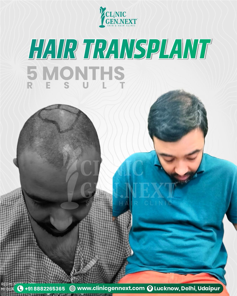 clinicgennext's tweet image. In just 5 months, the transformation speaks for itself! ✨
ClinicGenNext delivers natural density, a clean hairline, and strong regrowth with every Hair Transplant.
Start your hair restoration journey today — confidence is just one step away! 💼

#DrKunal #DrKunalSingh