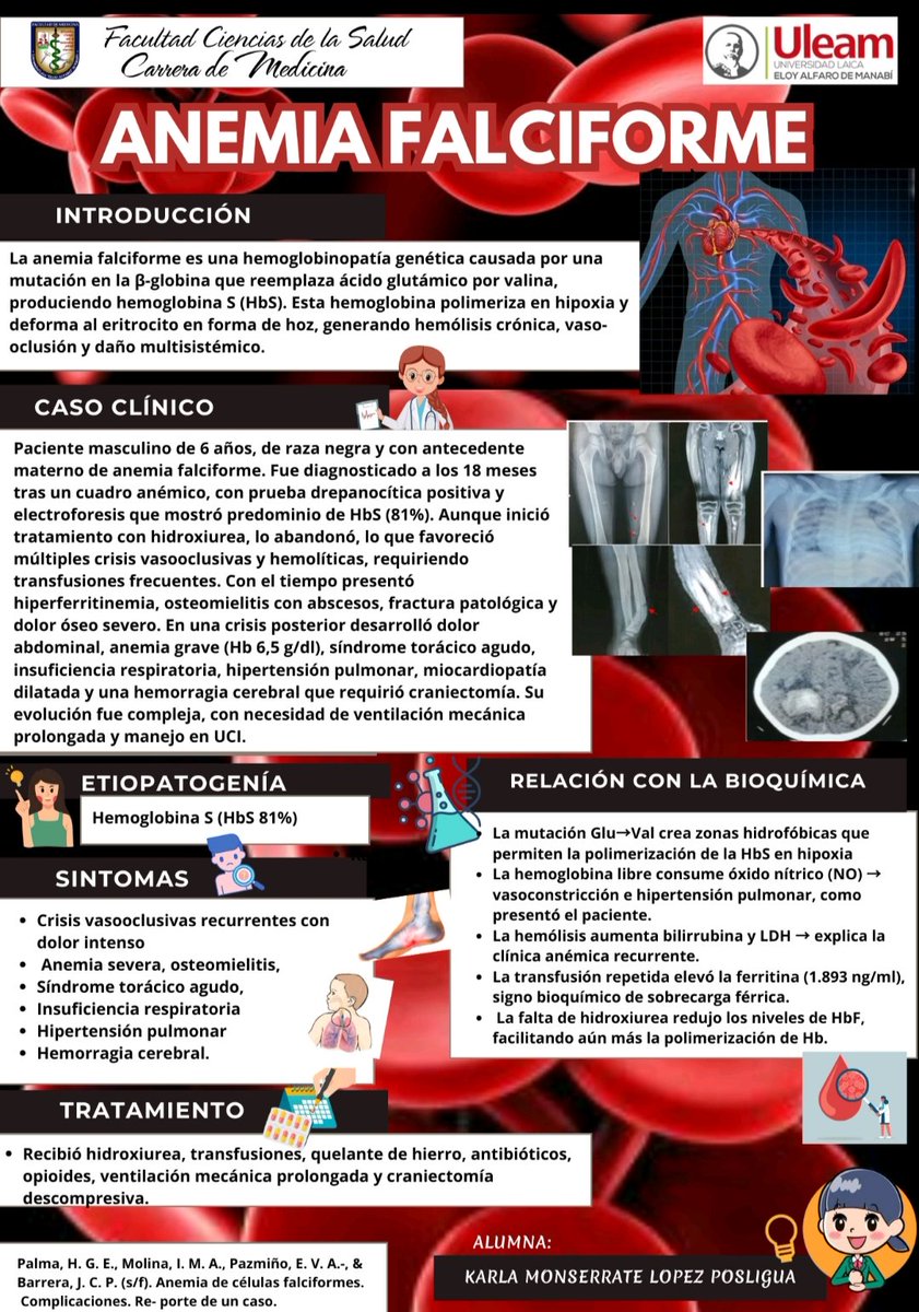 Karlalopezp03's tweet photo. Poster Científico Anemia Falciforme📌
 “La anemia falciforme no solo afecta la sangre: afecta la vida. Detectarla a tiempo salva futuros.”🫂
Conoce más sobre este caso Clínico ⬇️
Estudiante : Karla Lopez 
#UleamEsAcademia #Uleam40años #Medicina
@Anghelo77ac @UleamEcuador https://t.co/wmYuoURQm3