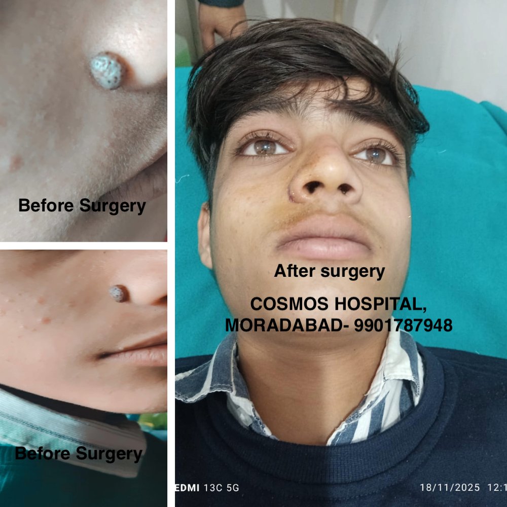 ANIRUDH_UP's tweet photo. #moleremovalsurgery #aestheticsurgery #moradabad #cosmoshospital #Anirudh https://t.co/y27F6aTRmA