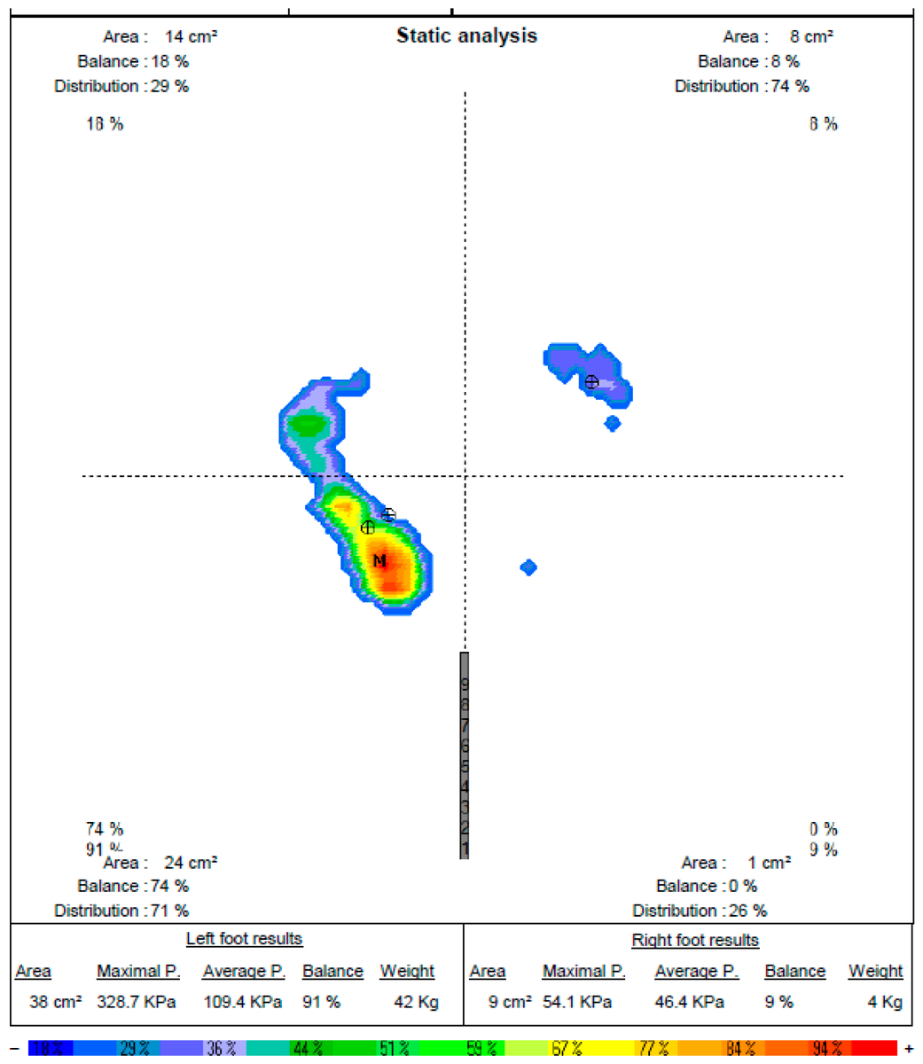 Prosthesis_MDPI's tweet image. 📊 Novel insights on static plantar pressure changes pre-/post-total knee arthroplasty in knee OA—key clinical/rehab implications.

Access the study: doi.org/10.3390/prosth… 

#TotalKneeArthroplasty #PlantarPressure #KneeOA