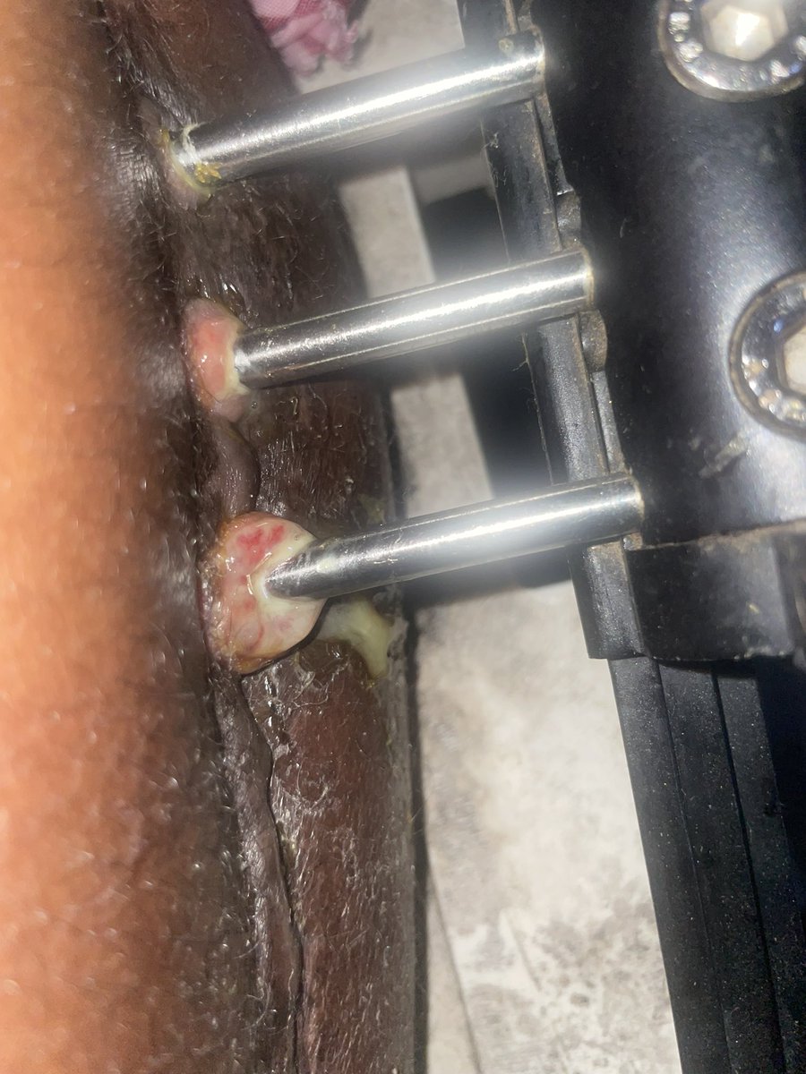 Aramide44936320's tweet image. Nigerian I am pleading for your help, i want a permanent solution for my leg. 

I can’t hold this pain again, kindly help my tag @Wizarab10 and the rest should come to my rescue. 

The pus coming out of my leg is too much, i don’t want to lose my leg 😭😭😭
