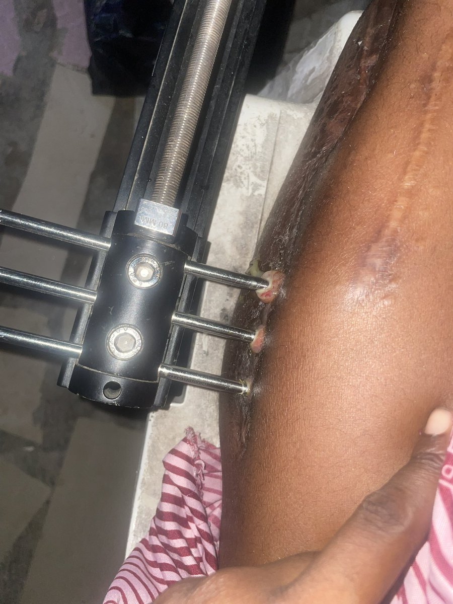 Aramide44936320's tweet image. Nigerian I am pleading for your help, i want a permanent solution for my leg. 

I can’t hold this pain again, kindly help my tag @Wizarab10 and the rest should come to my rescue. 

The pus coming out of my leg is too much, i don’t want to lose my leg 😭😭😭