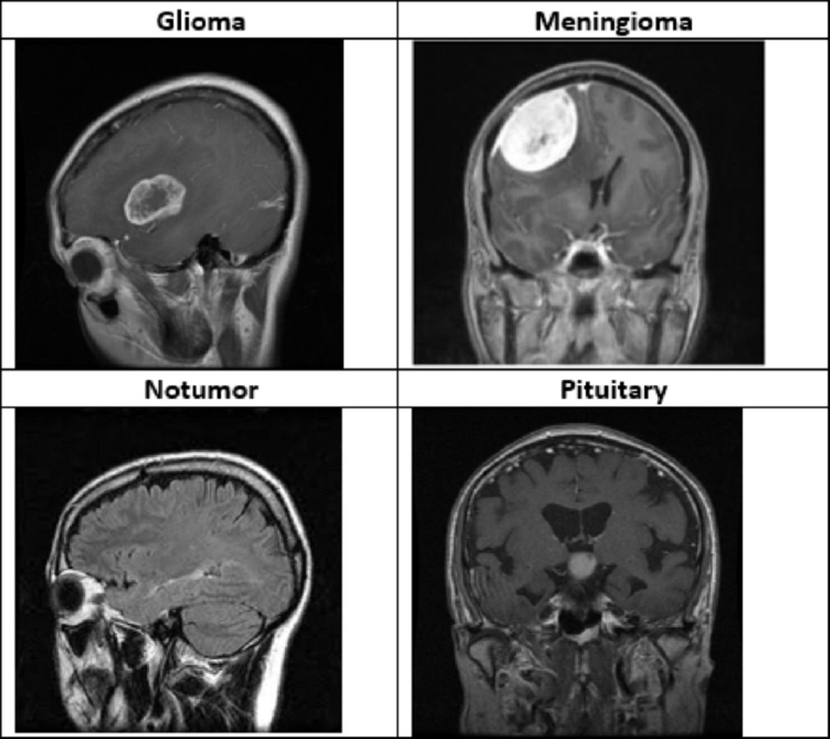 gp_pulipaka's tweet image. A Robust Deep Learning Ensemble Framework for Accurate Brain Tumor Classification! #BigData #Analytics #DataScience #AI #MachineLearning #IoT #IIoT #PyTorch #Python #RStats #TensorFlow #Java #HealthTech #ReactJS #GoLang #CloudComputing #Serverless #DataScientist #Linux…