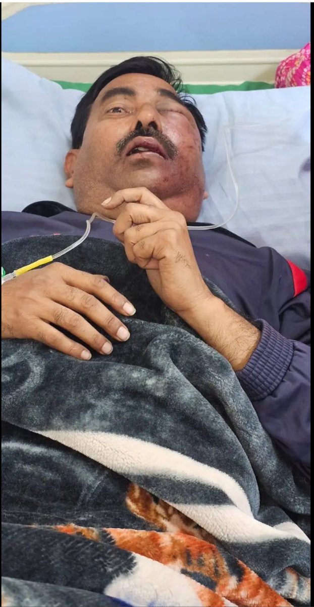 SudarshanNewsUp's tweet image. कल रात कुछ अज्ञात लोगों ने सुदर्शन न्यूज़ के कैमरामैन सुशील अवस्थी पर प्राण घातक हमला किया।

इस हमले में सुशील अवस्थी के काफ़ी चोटें आई है। देर रात उनको लखनऊ के लोकबंधु हॉस्पिटल में भर्ती कराया गया। हमलावरों के ख़िलाफ़ मुक़दमा दर्ज कराने के लिए मानक नगर थाने में तहरीर दी गई है।…