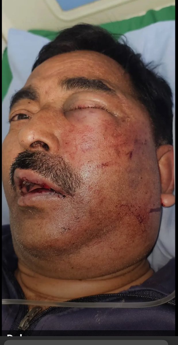 SudarshanNewsUp's tweet image. कल रात कुछ अज्ञात लोगों ने सुदर्शन न्यूज़ के कैमरामैन सुशील अवस्थी पर प्राण घातक हमला किया।

इस हमले में सुशील अवस्थी के काफ़ी चोटें आई है। देर रात उनको लखनऊ के लोकबंधु हॉस्पिटल में भर्ती कराया गया। हमलावरों के ख़िलाफ़ मुक़दमा दर्ज कराने के लिए मानक नगर थाने में तहरीर दी गई है।…