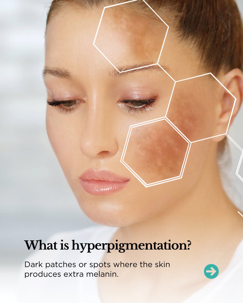 aesthetictreats's tweet image. Book #StellarM22 treatments at RP Aesthetics to reduce #hyperpigmentation for good. 

Most clients see improvement over 3-6 sessions spaced 4-6 weeks apart. For best results, pair with daily #SPF, #Obagi skincare &amp;amp; avoid tanning.

Call 0191 281 8775 to schedule your appointment.