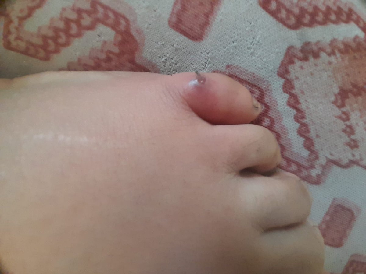 DalulainGaza's tweet image. 🥺I woke up to my baby screaming. I don&apos;t know what bit her. We live on the streets in tents; it&apos;s a harsh life. Please help me so I can move around and get my baby treatment. Please don&apos;t ignore this. 🙏🙏
chuffed.org/project/138194…