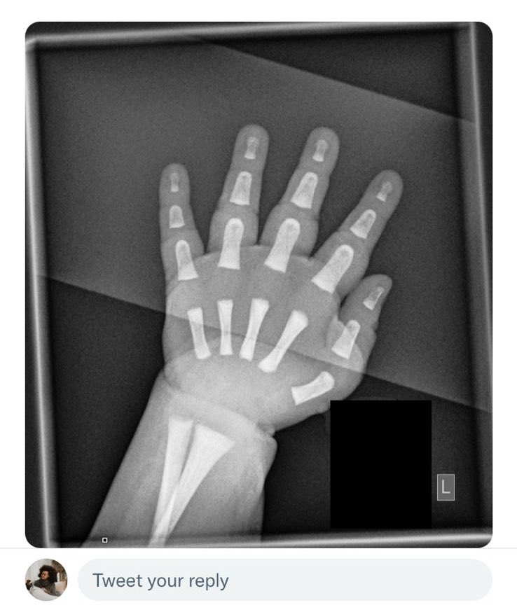 Babies’ little bones are floating in fat for the first few months of their life. Nothing holding them together- just the Holy Spirit &amp; fat 🥰