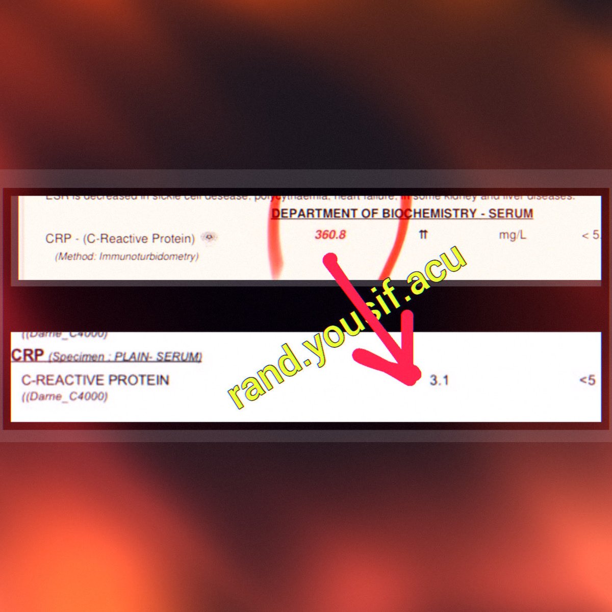 أتاني من خارج بريطانيا بعد أن سافر الهند والسند ولم يجدوا له علاجا وافيا سوى المسكنات ومعاناة من الروماتويد الي المفروض يكون في الدم أقل من خمسة

 في البداية كان التحليل 360 

سافروا به إلى مصحة للعلاج بالغذاء فقط نزل التحليل وصار 9 شوفوا تأثير الغذاء الصحي 

لكن الاهل لم يكتفوا