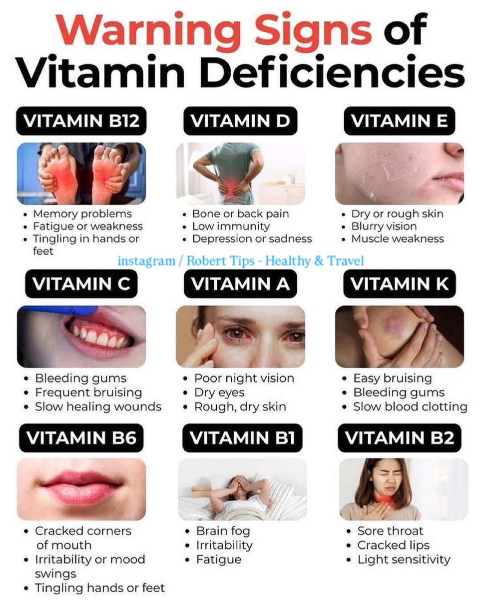 Warning Signs of Vitamin Deficiencies