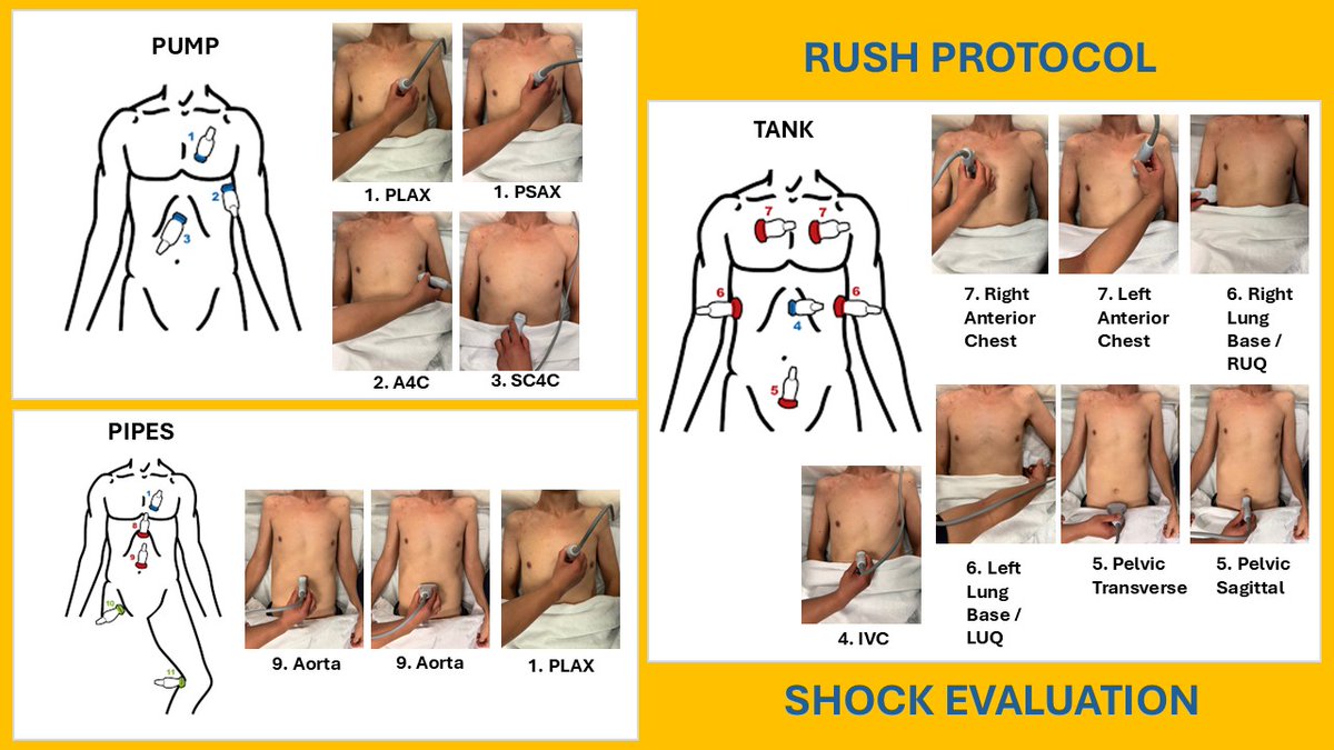 pocus_today's tweet image. #POCUS #useit RUSH Protocol - Pump, Tank and Pipes 
SHOCK Evaluation

de-intensivist.nl/wp-content/upl…