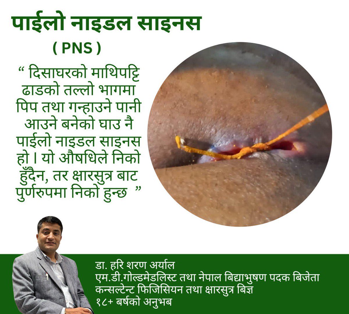 Drharisharan's tweet photo. “ दिसाघरको माथिपट्टि ढाडको तल्लो भागमा पिप तथा गन्हाउने पानी आउने बनेको घाउ नै पाईलो नाइडल साइनस हो I यो औषधिले निको हुँदैन, तर क्षारसुत्र बाट पुर्णरुपमा निको हुन्छ ”
आवस्यक परेमा सम्पर्क गर्नुहोला I
व्ह्याट्सयाप नम्बर : ९७६८३८४०४४
#pilonidalsinus #drharisharanaryal #ksharsutra https://t.co/QKlV958zFi
