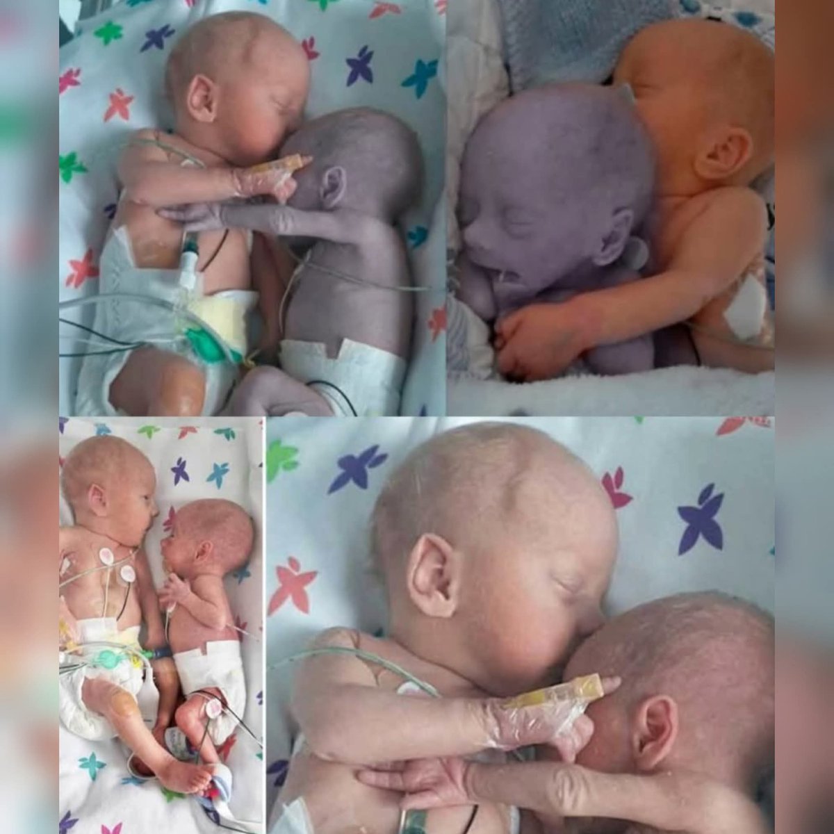 A nurse placed the healthy baby next to her dying twin sister… and what happened next truly revolutionized medicine.

In 1995, at a Massachusetts hospital, two premature twins, Kyrie and Brielle, were fighting for their lives. Kyrie was gradually getting stronger… but her