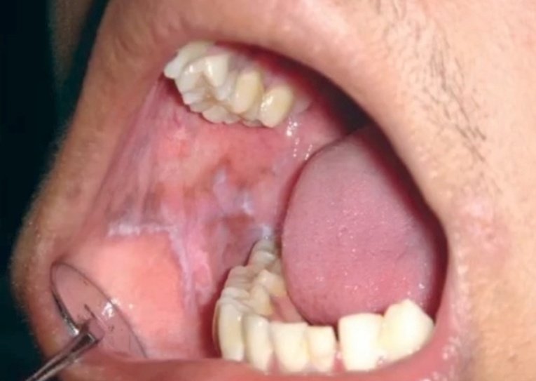 nervemed's tweet image. What is the most likely diagnosis❓

A. Oral Lichen Planus
B. Oral Candidiasis
C. Leukoplakia
D. Aphthous Ulcer