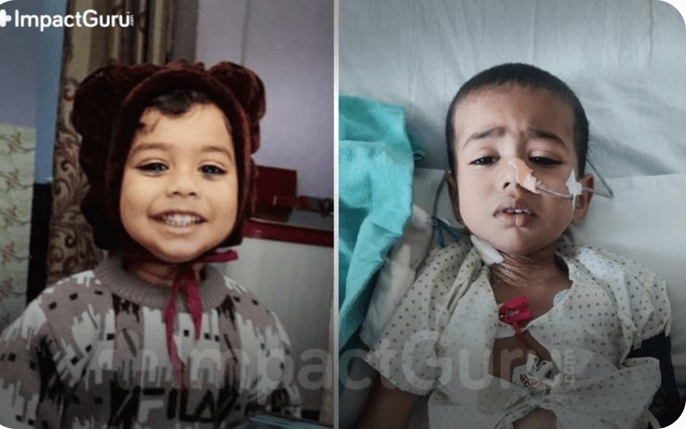 venkat_grid's tweet image. 2 Y/O Manvit’s Voice Trembles With Fear Everytime He Tries To Speak”
👇
impactguru.com/s/DvsfdT

@NayabSainiBJP @cmohry @NHMHRY @ArtiSinghRao
@MoHFW_INDIA @PMOIndia @JPNadda @BMGFIndia @SoodFoundation @urstrulyMahesh @MBfoundationorg @AnilAgarwalFndn #helpdynamogaming @SonuSood