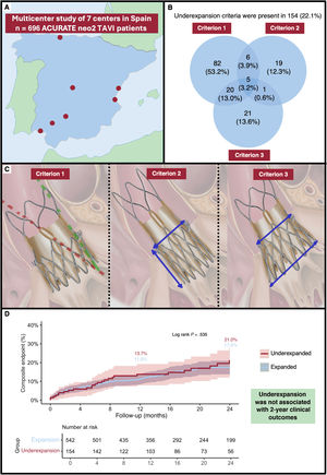 RevEspCardiol's tweet image. Failure of the new underexpansion criteria to predict outcomes after ACURATE neo2 valve implantation: results from an independent multicenter registry #REC #Aheadofprint @MPAOSS @rafaelglezm @Srg_gb @RuizNodarJM @albabfc @he1thj @Dr_DanielTebar @NachoGalloFer @claurivare…