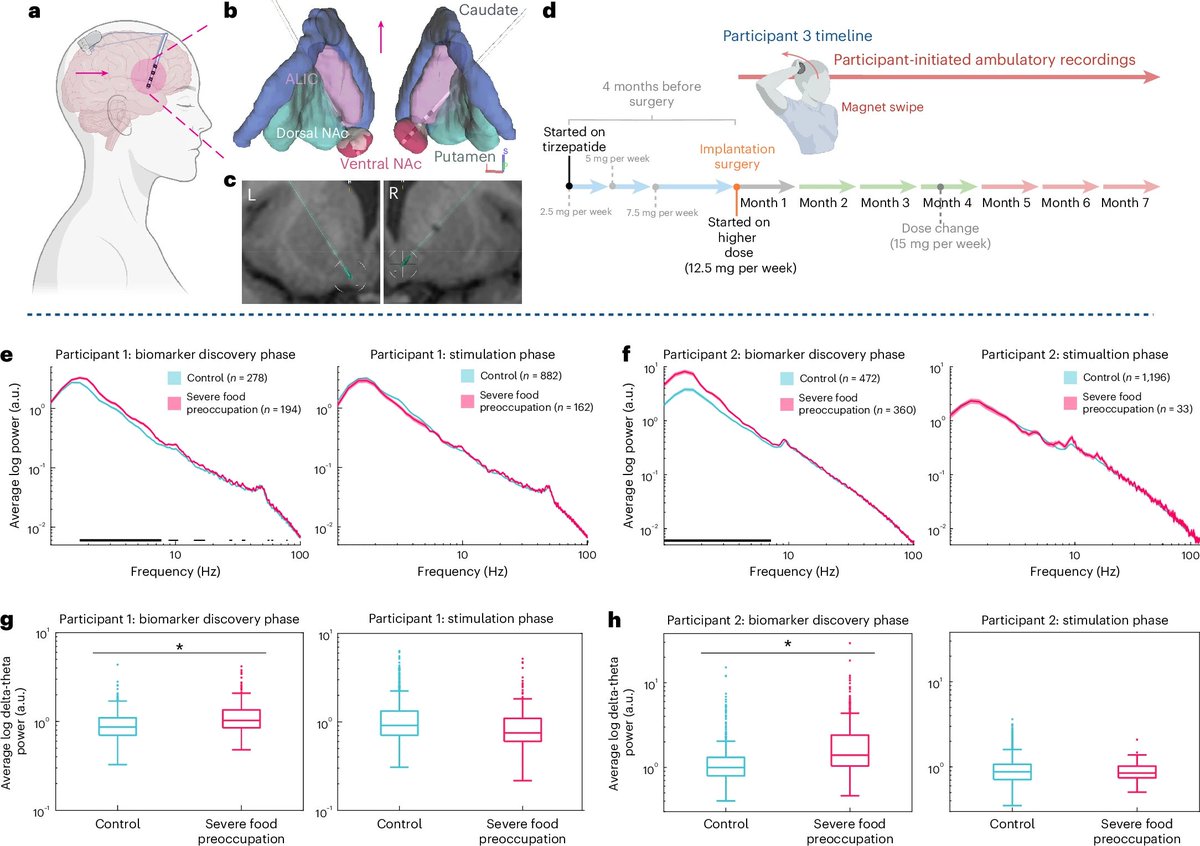 New in <a href="/NatureMedicine/">Nature Medicine</a>, <a href="/halpernc/">Casey H. Halpern</a>'s team looked at the brain activity of a patient with loss of control eating on tirzepatide and revealed it may only temporarily suppresses signaling in the brain’s “reward center” thought to be involved in food noise.

➡️ spr.ly/601979uMX