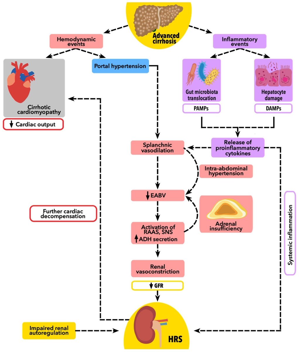 🧬𝗙𝗶𝘀𝗶𝗼𝗽𝗮𝘁𝗼𝗹𝗼𝗴𝗶́𝗮 𝗱𝗲𝗹 𝘀𝗶́𝗻𝗱𝗿𝗼𝗺𝗲 𝗵𝗲𝗽𝗮𝘁𝗼𝗿𝗿𝗲𝗻𝗮𝗹
🫀➜🫁➜🩸➜🧂➜🟡🧂
⬇️⬇️⬇️⬇️ 

📌𝘾𝙞𝙧𝙧𝙤𝙨𝙞𝙨 𝙖𝙫𝙖𝙣𝙯𝙖𝙙𝙖 → 𝙝𝙞𝙥𝙚𝙧𝙩𝙚𝙣𝙨𝙞𝙤́𝙣 𝙥𝙤𝙧𝙩𝙖𝙡
📌→ 𝙑𝙖𝙨𝙤𝙙𝙞𝙡𝙖𝙩𝙖𝙘𝙞𝙤́𝙣 𝙚𝙨𝙥𝙡𝙖́𝙘𝙣𝙞𝙘𝙖 → ↓ 𝙫𝙤𝙡𝙪𝙢𝙚𝙣