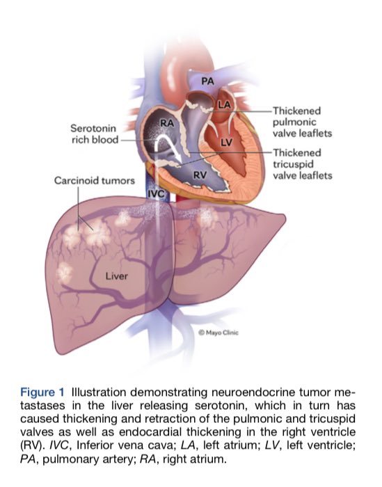 Ed_Alania's tweet image. 🔵 Echocardiographic Evaluation of Carcinoid Heart Disease @JournalASEcho #Cardiology #CardioEd #echofirst #FOAMed