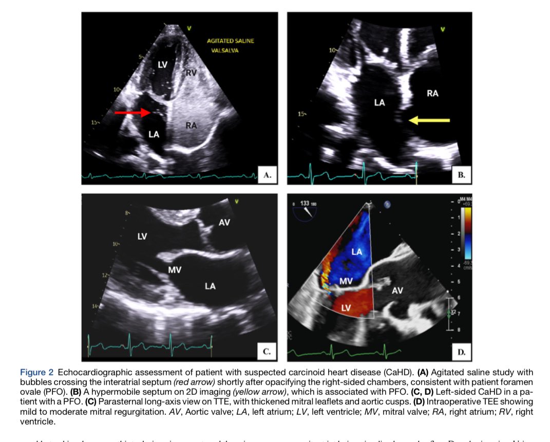 Ed_Alania's tweet image. 🔵 Echocardiographic Evaluation of Carcinoid Heart Disease @JournalASEcho #Cardiology #CardioEd #echofirst #FOAMed