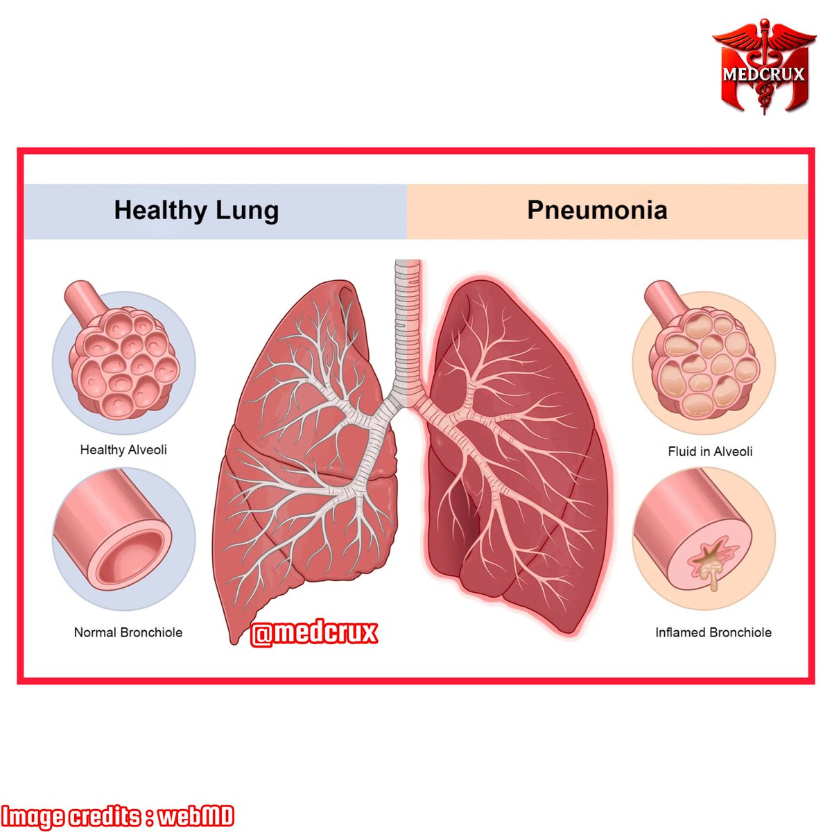 medcrux's tweet image. 🔥 The Pneumonia Mnemonic Every Medico Should Know

💊 Typical Pneumonia Bugs → S.H.K.M.P.
📍 S — Strep pneumoniae
📍 H — H. influenzae
📍 K — Klebsiella
📍 M — Moraxella
📍 P — Pseudomonas

🦠 Atypical Pneumonia Bugs → L.M.C.V.
📍 L — Legionella
📍 M — Mycoplasma
📍 C —…