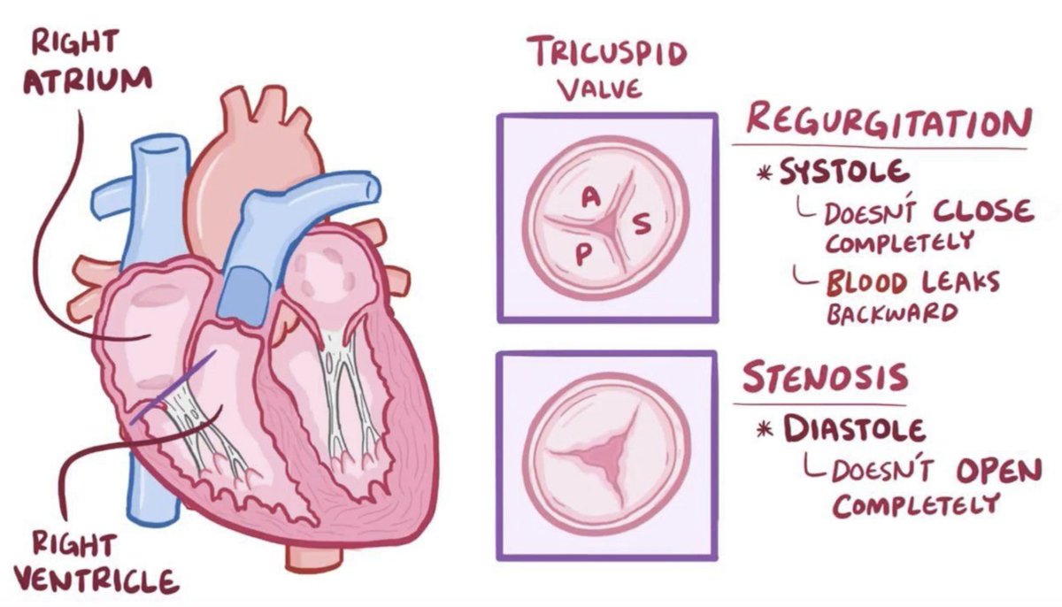 USMLEStepStudy's tweet image. Tricuspid stenosis - rare diastolic, harsh, rumbling lower frequency murmur, LLSB (not apex) 4th ICS; MCC: rheumatic heart dz, carcinoid tumors, endocarditis, radiation, fibrosis; Rx: valve repair or replacement, percutaneous balloon valvuloplasty