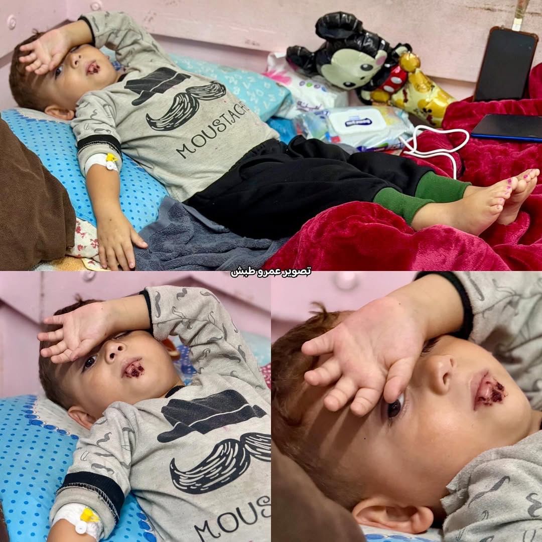 QudsNen's tweet image. Palestinian child Riad Al-Homs, suffering from spinal cord cancer in Gaza, received his first chemotherapy dose today. 

His fragile body could not tolerate the treatment, leaving him in critical condition. Doctors administered the therapy as a last resort to save his life, but…