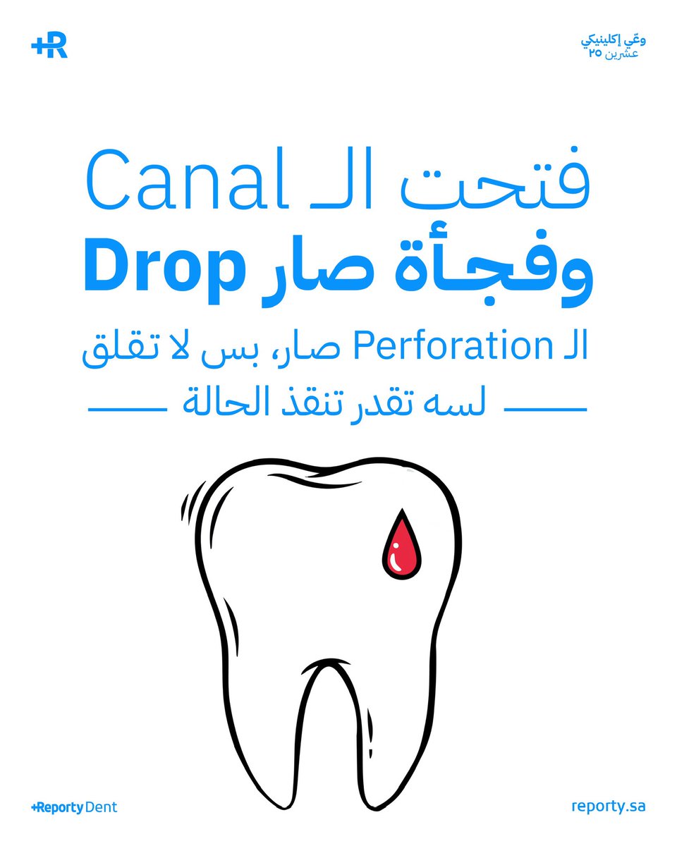 قبل تبدأ تتصرف، لازم تفهم وش اللي صار بالضبط
الـ Perforation له أكثر من نوع، ومكانه يغيّر الخطة بالكامل 🔢🔄

- Coronal غالباً يصير أثناء الـ access
- Mid-root نتيجة over-instrumentation
- Apical أحياناً يختلط عليك مع الـ canal
- Furcation وقت البحث عن canals في الـ molars

كيف
