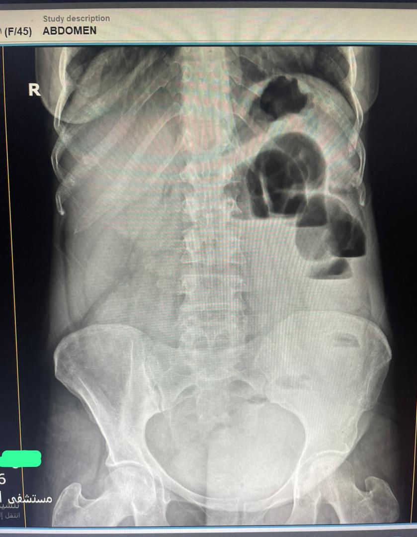 EchoTech_4's tweet image. 45 years female Presented with diffuse abdominal pain , persistent vomiting and bloody stool 

And a palpable abdominal mass seen to the RT of the umbilicus

#EchoTech #Ultrasound #GIT