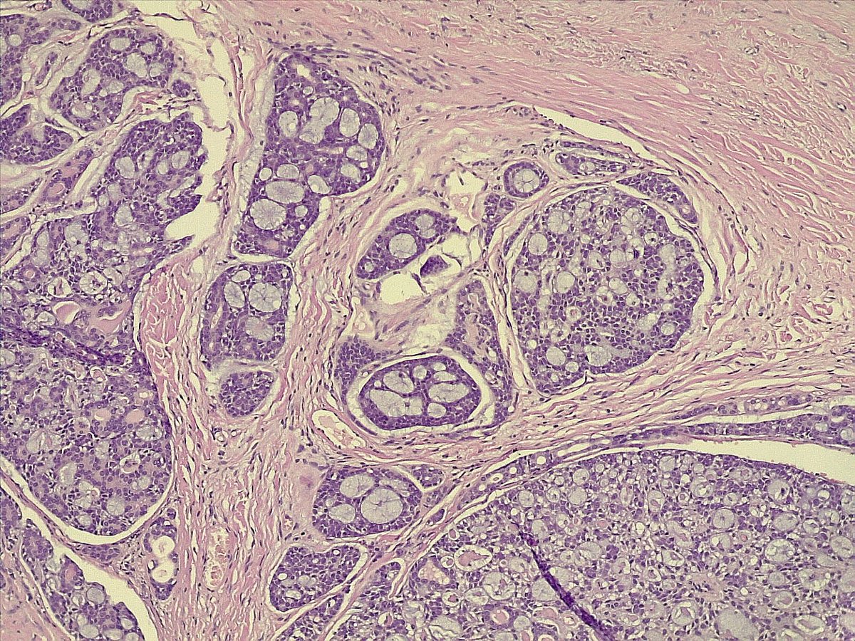 ariabdullah1978's tweet image. Yup it is adenoid cystic carcinoma
Check the histology and IHC bellow