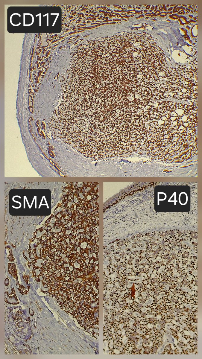 ariabdullah1978's tweet image. Yup it is adenoid cystic carcinoma
Check the histology and IHC bellow