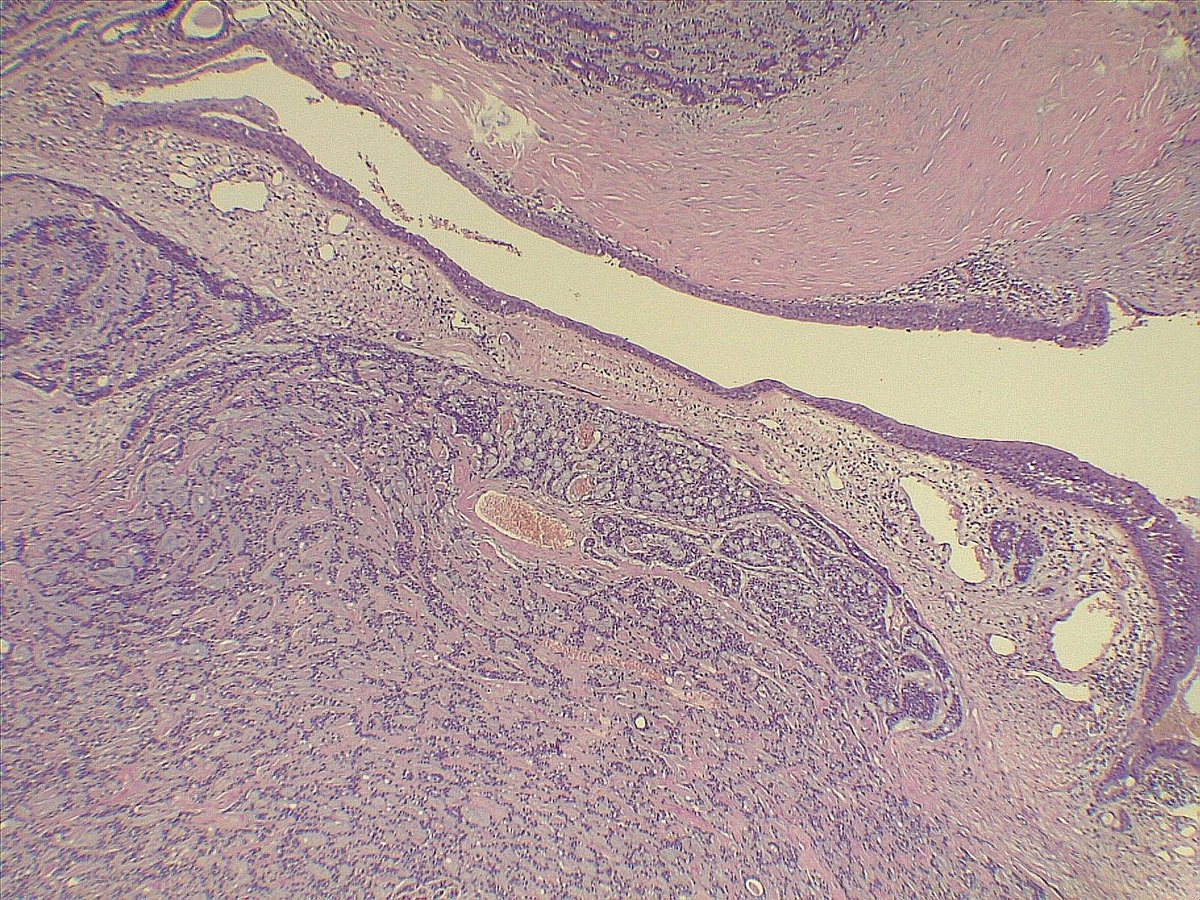ariabdullah1978's tweet image. Yup it is adenoid cystic carcinoma
Check the histology and IHC bellow