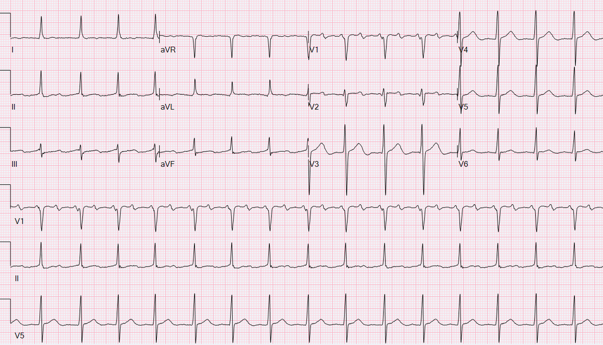 Two to One - Never forget your flutter line!
#NonCTI #AFl #AT #RF