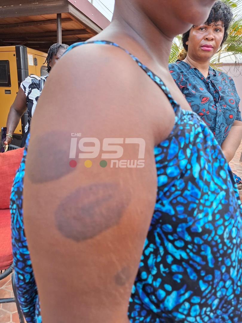 The1957News's tweet image. WATCH | Photos of the woman who was physically assaulted by her husband in a viral video, showing the marks left on her body.