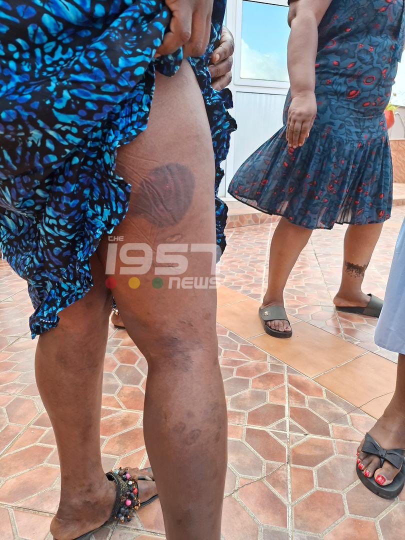 The1957News's tweet image. WATCH | Photos of the woman who was physically assaulted by her husband in a viral video, showing the marks left on her body.