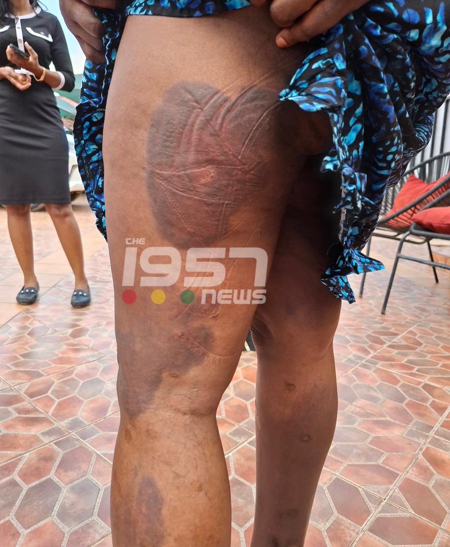The1957News's tweet image. WATCH | Photos of the woman who was physically assaulted by her husband in a viral video, showing the marks left on her body.