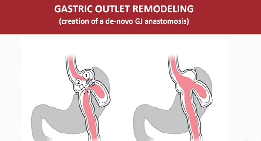 videogie's tweet image. Kambiz Kadkhodayan, MD, et al explain the EUS-assisted gastric outlet remodeling procedure. youtu.be/Fve-wQQAx_s

#GITwitter 

@Kkadkhodayan