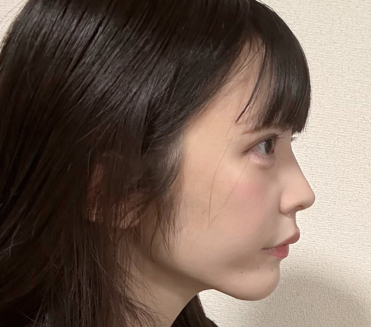 さつき@整形垢 (@satsuki72727) / Posts / X